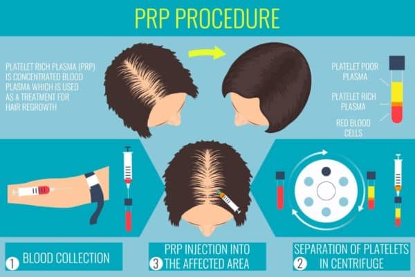 PRP For Hair Loss